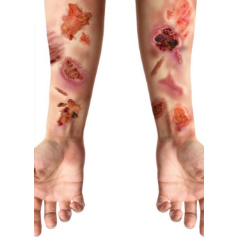 Tatuaje de Heridas Infectadas